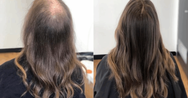 The Best Hair Loss Treatment For Women: A Complete Guide to Regaining Confidence and Healthy Hair